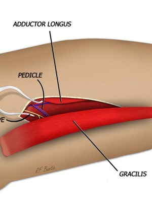 icongracilis