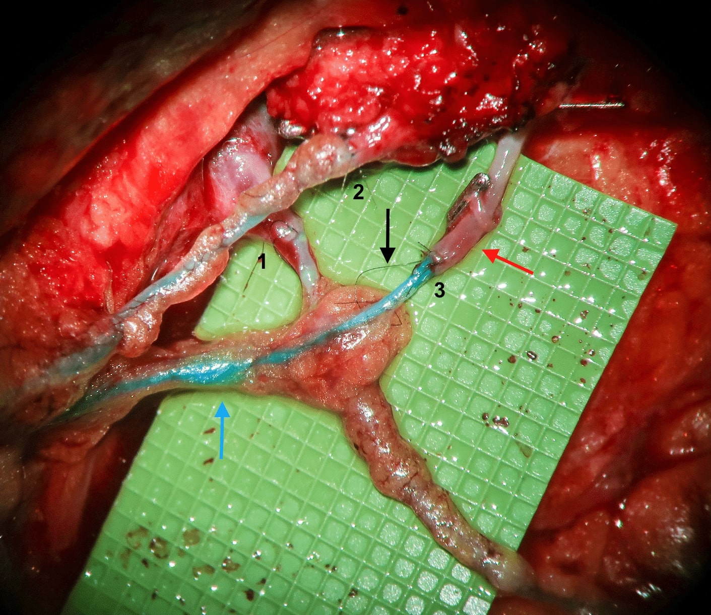 lymphovenous bypass 1