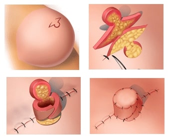 nipple reconstruction cv flap