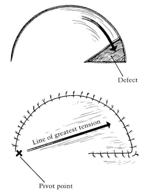 rotation flap