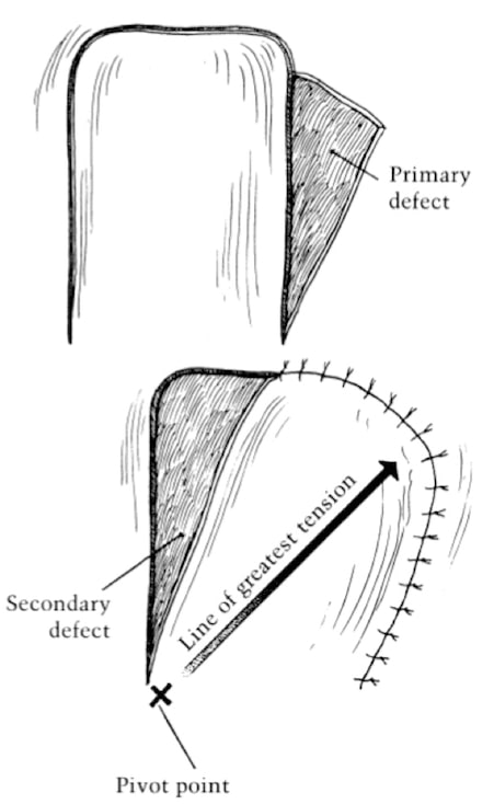 transposition flap