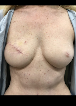 After Image: DIEP Free Flap Breast Reconstruction - front