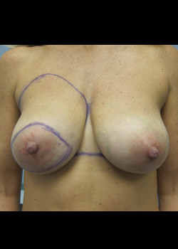 Breast Reconstruction with Implants