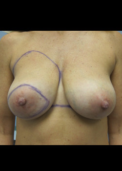 Before Image: Breast Reconstruction with Implants - front