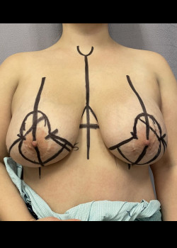 Before Image: Breast Implant Removal with Total Capsulectomy and Mastopexy - front